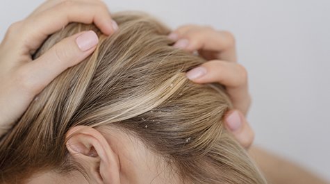 Seboroická dermatitída: Ako ju rozpoznať a dostať pod kontrolu?