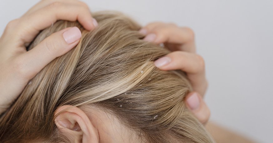 Seboroická dermatitída: Ako ju rozpoznať a dostať pod kontrolu? - hero
