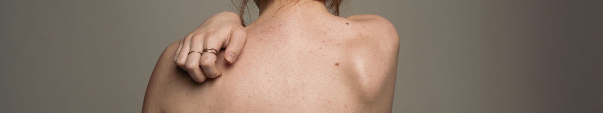 Ako si poradiť s hnedými škvrnami na koži? - header