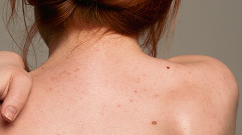 Ako si poradiť s hnedými škvrnami na koži?
