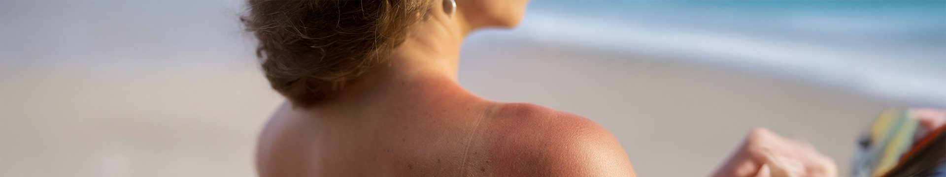 Ako sa zbaviť vyrážok a škvŕn od slnka? - header