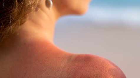 Ako sa zbaviť vyrážok a škvŕn od slnka?