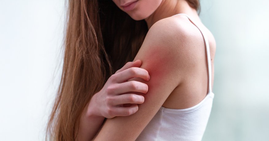 Aké sú najčastejšie druhy ekzému a ako ich rozpoznať? Hero