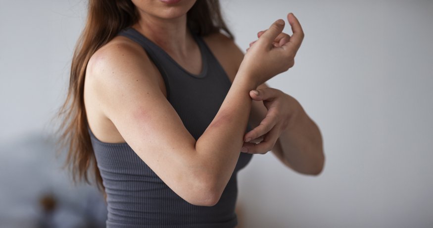 Čo je dermatitída a ako spoznať, že sa týka práve vás - Hero