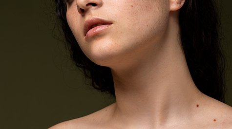 Hnedé škvrny na koži a ako sa ich zbaviť 