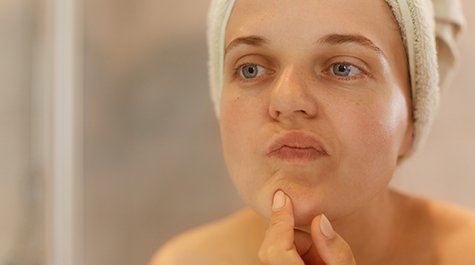 Problematická pleť: Ako sa o ňu starať?